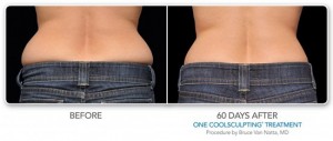 Loudoun County Premier CoolSculpting Provider