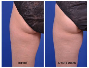 liposuction alternative Archives - Elite Body Contouring in Northern  Virginia