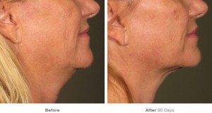 Ultherapy Before and After at Avie MedSpa in Leesburg, VA