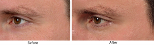 See the improvement! Before and after picture of combining micro therapy with Skin Medica's TNS Recovery Complex!