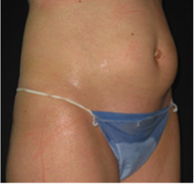 liposuction alternative Archives - Elite Body Contouring in Northern  Virginia