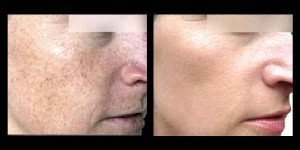 Leesburg, VA Photofacial Before and After at AVIE! Medspa and Laser Center. 