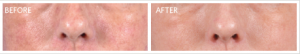 Before and after picture from AVIE! Medspa's Skin Care Boot Camp!