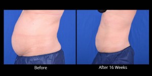 AVIE! Medspa CoolSculpting before and after pictures in Leesburg, VA.