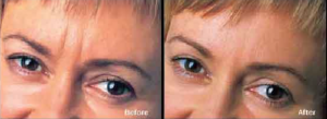 Dysport Before and After photo at AVIE! Medspa and Laser Center in Leesburg, VA. 