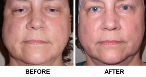 Before & After photo of an AVIE! BBL photofacial in Leesburg, VA.