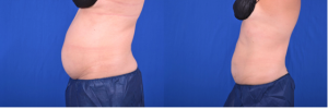 Before and After images of CoolSculpting at AVIE! Medspa and Laser Center in Leesburg, VA.