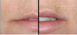 Restylane Silk before and after in Leesburg, VA at AVIE! Medspa.