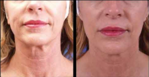 Before and After of Ultherapy treatments at AVIE! Medspa in Leesburg, VA.