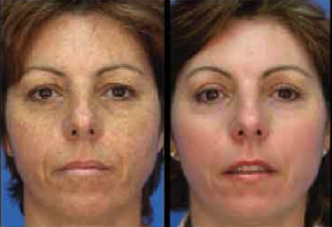 Before and After MicroLaserPeel treatment in Leesburg, VA at AVIE! Medspa and Laser Center.