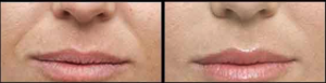 Before and After of dermal fillers for smile lines in Leesburg, VA at AVIE! Medspa and Laser Center.