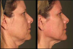 Ultherapy at AVIE! Medspa in Leesburg, VA can result in an uplifted appearance!
