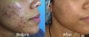 HydraFacial at AVIE! Medspa in Leesburg, VA can improve the appearance of acne!