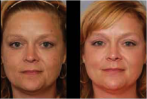 before-after-photofacials-leesburg-va