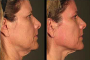 ultherapy-before-and-after-avie-medspa-leesburg-virginia