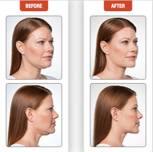 Kybella at AVIE! Medspa in Leesburg, VA provides dramatic results in reducing double chin!