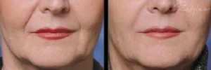 Reduce fine lines around the lips with lip rejuvenation treatment in Leesburg, VA!