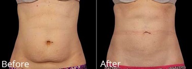 See incredible slimming results with CoolSculpting at AVIE! MediSpa and Laser Center!