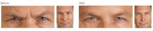 Botox in Leesburg provides dynamic, smooth results!