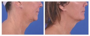 Check out the amazing results from Ultherapy in Leesburg, VA!