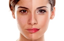 Ultherapy is all the rage for its ability to tighten and lift the skin on your face, neck, chin, jawline, and brow.