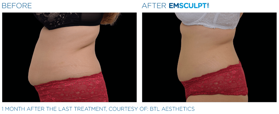 emsculpt neo before & after at avie medspa in leesburg, va 1