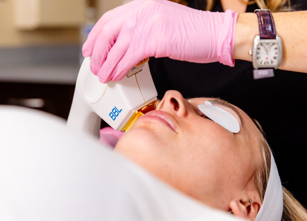 Provider wearing gloves places a handheld laser device onto a patient’s cheek for a treatment with the BBL HERO in Leesburg. The patient lies back wearing protective eye covers.