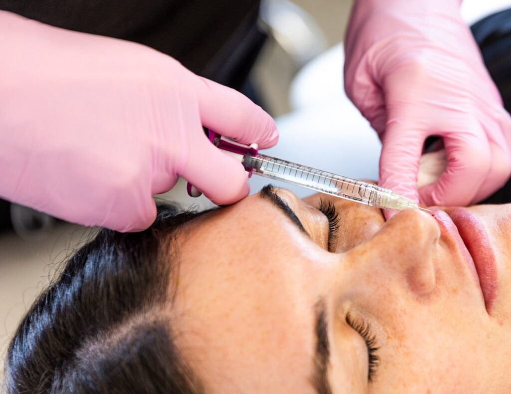 Provider precisely injects lip fillers in Loudoun County into patient's top lip to provide subtle enhancements to its size and shape.