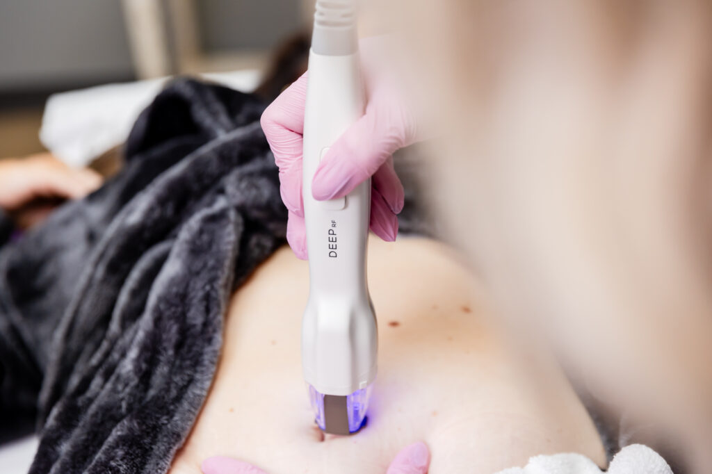 Provider wearing gloves places the handheld Skin Pen device on patient's body as part of a series of treatments for microneedling in Leesburg.