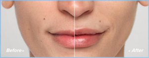 Restylane Silk Leesburg, VA before and after.