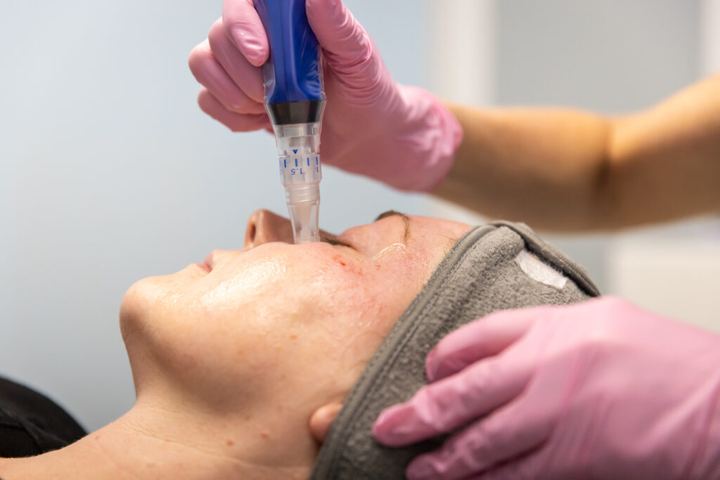 Provider places the SkinPen microneedling device on patient's cheek to boost collagen production. This is part of a series of sessions for microneedling near Alexandria.