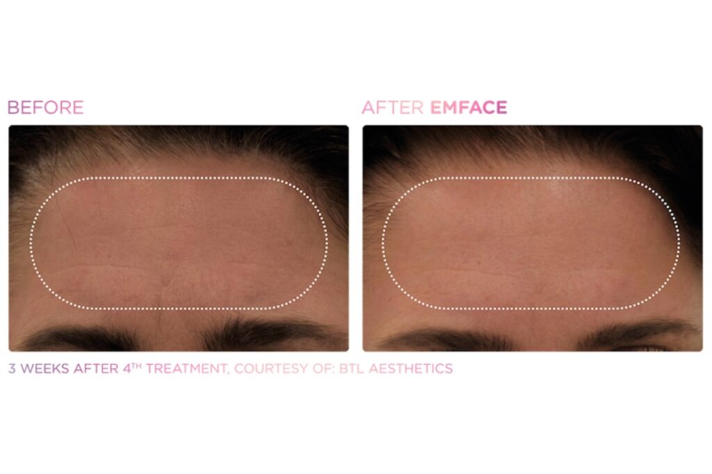 Emface before and after photos of a woman's forehead with significantly less fine lines in the after photo.