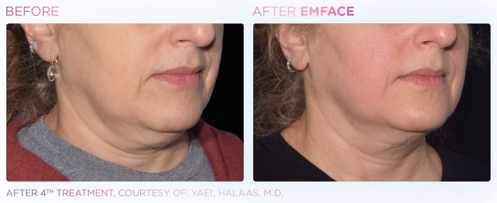 Emface before and after photos in Loudoun County of a woman's jawline looking more slim and defined in the after photos