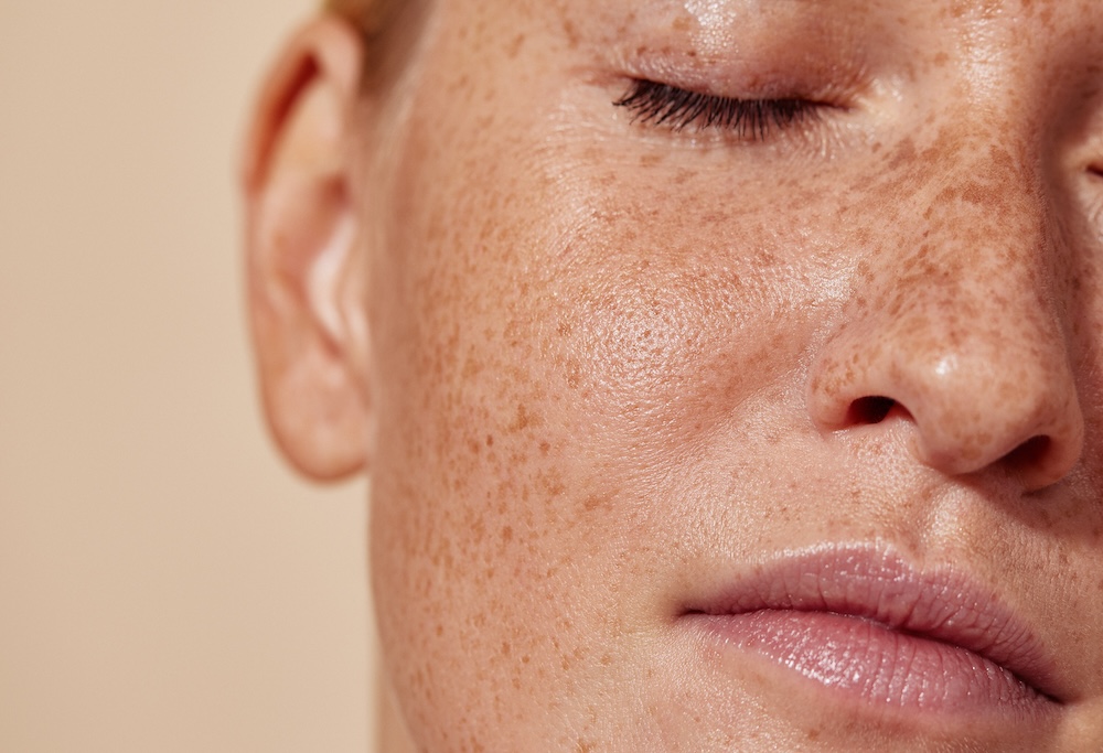 Woman relaxes face and has eyes closed. Her skin is covered in freckles and she's wondering what is the best treatment for brown spots on face in Loudoun County.